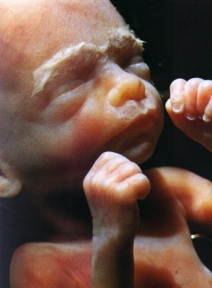 fetus at 6 weeks. Fetuses