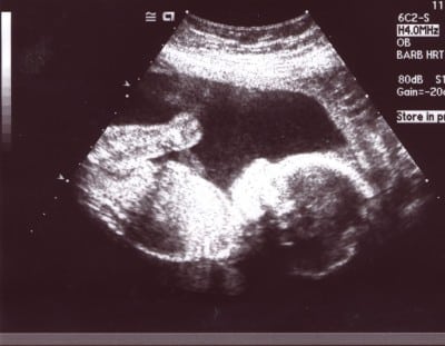 Baby Ultrasound Pictures on Ultrasound Picture   Growing Your Baby
