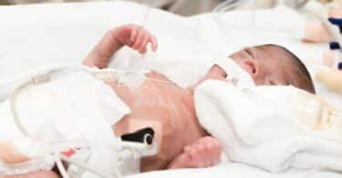 tiny premature baby in NICU