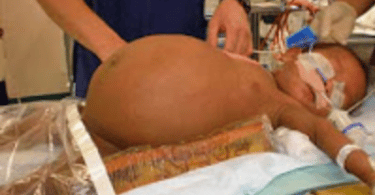 Surgeons Remove 8lb Tumour From East Timorese Baby