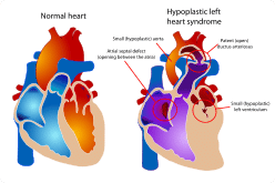hypoplastic left heart syndrome (HLHS)