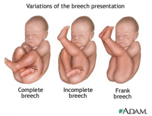 breech-baby