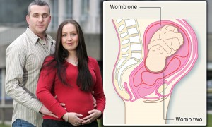 UK Mom With Two Wombs Welcomes Baby Girl