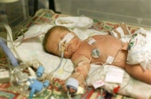 Research Suggests Stem cells Could Help Lung Development In Preemies