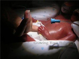 Born Too Early:  Meet 23 Weeker Amelia Pearl
