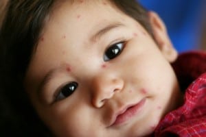 Study: Unvaccinated Kids more at risk of Varicella illness