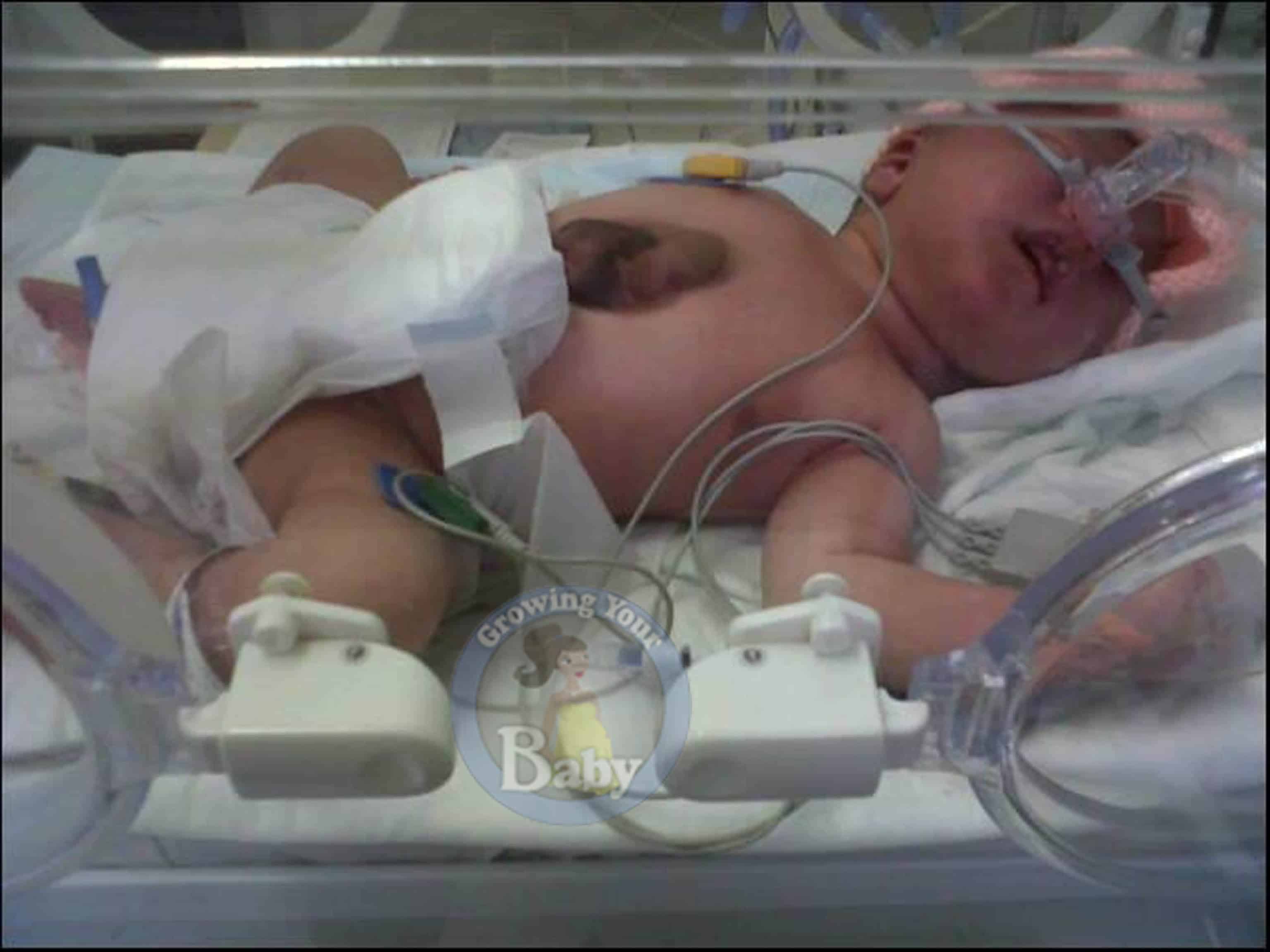 Little Fighter Born With Heart Outside Her Body