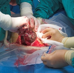 Cesarean section birth