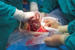 cesarean section birth