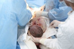 Baby Being delivered By C-Section