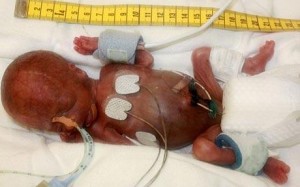 Tiny Baby Survives After Arriving Weighing  Just 9 Ounces