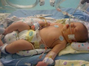 Baby Born With Birth Defect Denied Health Coverage