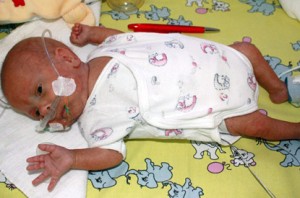 Tiny Baby Survives After Arriving Weighing  Just 9 Ounces