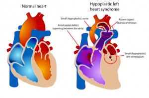 Hypoplastic Left Heart Syndrome Diagram
