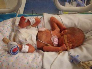 25 week old premature baby