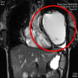 teratoma tumour