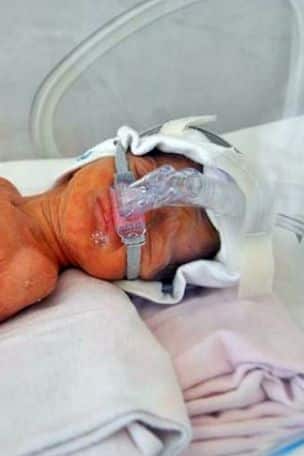 One of the premature twins on CPAP