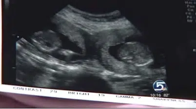 Ultrasound of the two babies