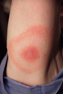 lyme disease rash