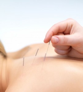 woman getting acupuncture