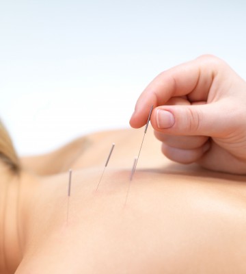 woman getting acupuncture