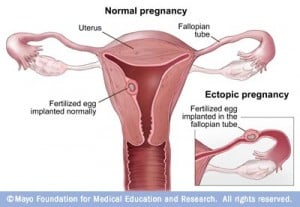 ectopic pregnancy