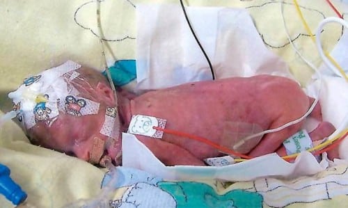 Baby Sive at birth with an iv in her head because doctors couldn't find any other veins