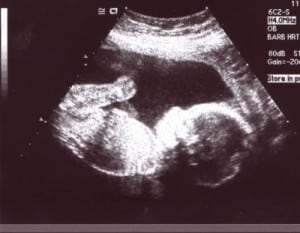 ULTRASOUND PICTURE
