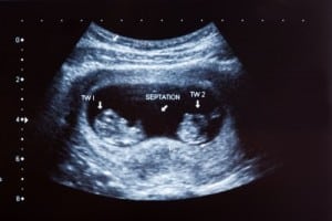 twin ultrasound