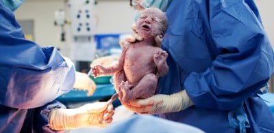 Cesarean Birth