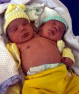 Conjoined baby with 2 heads Brazil
