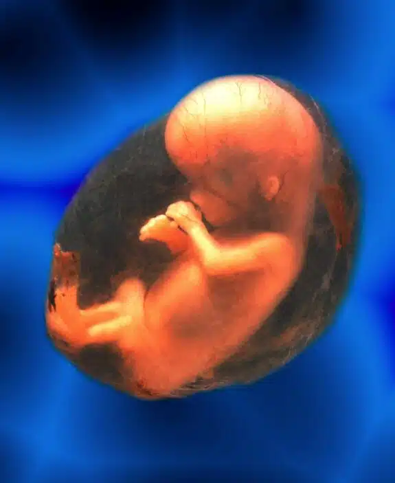 10 week fetus in sack 