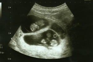 Emma Robbins quadruplet ultrasound