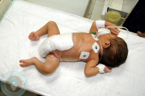 Baby with 6 limbs saved with surgery