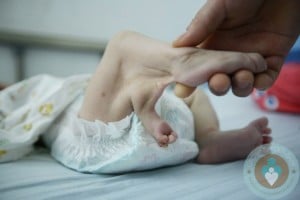 3 legged baby girl abandoned, China