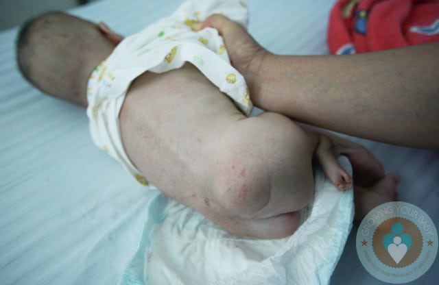 3 legged baby girl abandoned in China