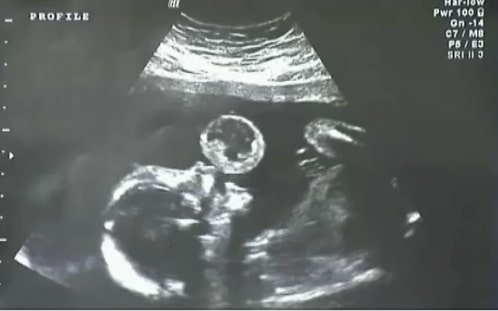 Leyna Gonzalez in utero