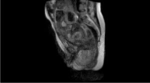 MRI childbirth
