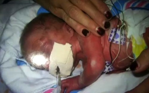 Lesley Coley's premature baby