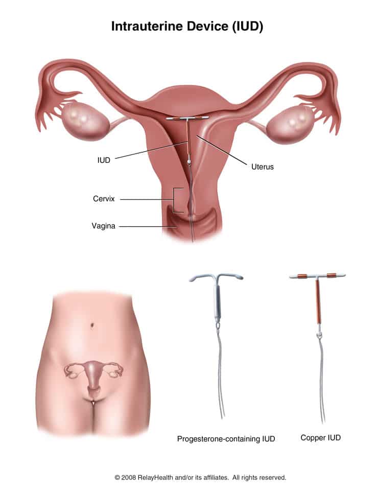 Best birth control options after pregnancy