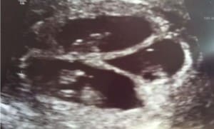 quadruplets ultrasound(2 singles and 1 set of identicals)