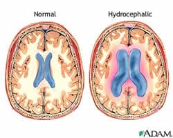 Hydrocephalus