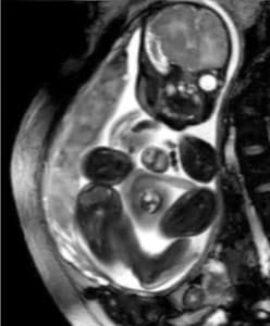 Ultrasound ectopia cordis