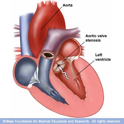 Aortic stenosis