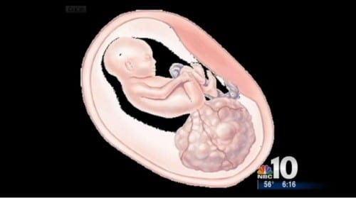 Sacrococcygel Teratoma on an infant inutero