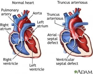 truncus arteriosus