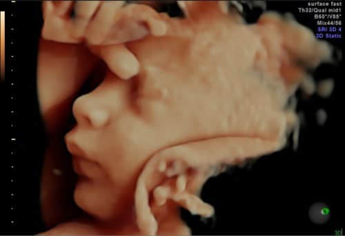 GE HDlive fetus still