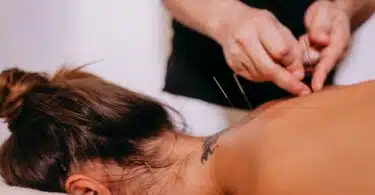 acupuncture