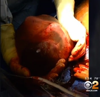 26 week preemie baby born in his amniotic sac