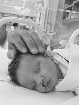 Baby Tate Burley suffers from a rare brain disorder